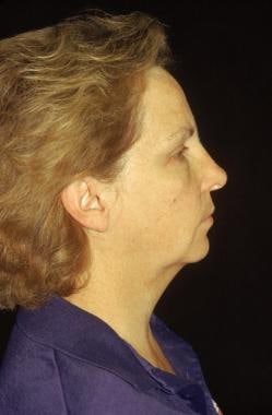 Midface facelift. Before: lateral view. Note the h
