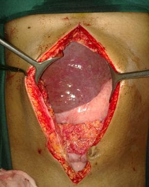 Abdominal incision is completed to reveal intra-ab