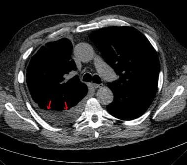 CT scan of chest in same patient with right pleura