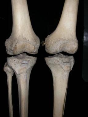 Knees, as seen from front, showing normal valgus a