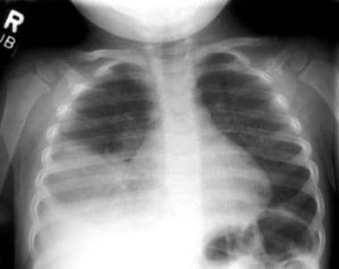 Right lower lobe consolidation in a patient with b