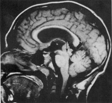 MRI of a 21-year-old man with a germinoma in the p