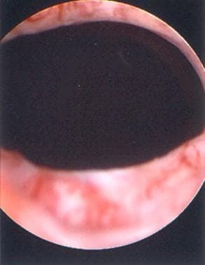 Rounding of the urethra at the level of the bladde