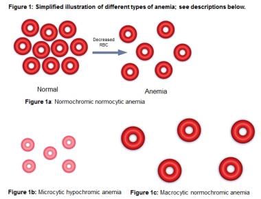 Anemia Lab Values Chart