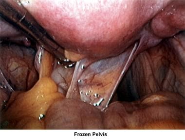 Infertility. Frozen pelvis. Image courtesy of Jair