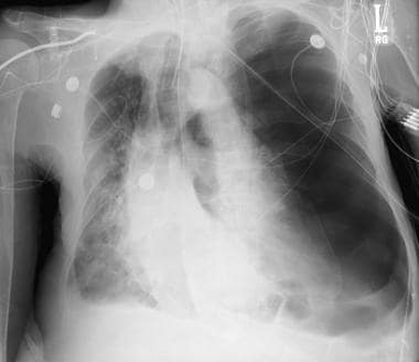 This patient developed a left tension pneumothorax