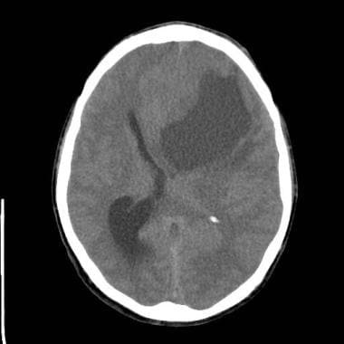 Brain abscess. A large left frontal low-density ma
