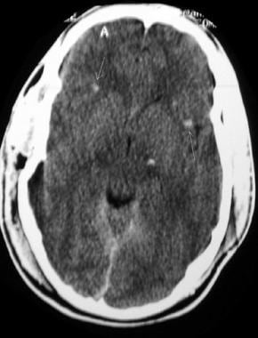 Noncontrast computed tomography scan of a trauma p