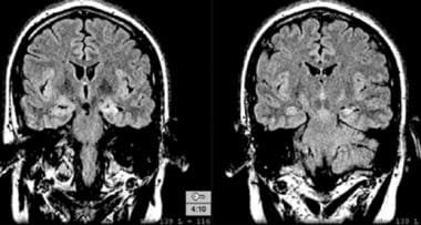 A 22-year-old patient with refractory temporal lob