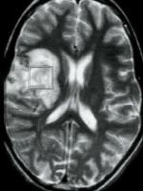 T2-weighted magnetic resonance image of a patient 