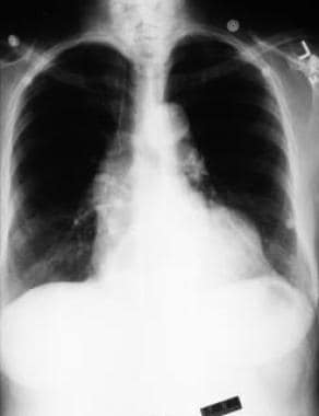 Aortic regurgitation. Chest radiograph in a patien
