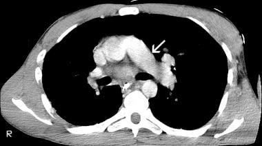 Axial CT scan of the superior mediastinum obtained