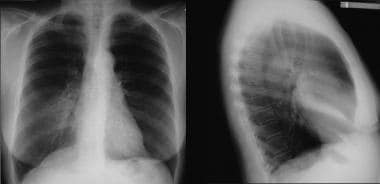 Posteroanterior (PA) (left) and lateral chest (rig
