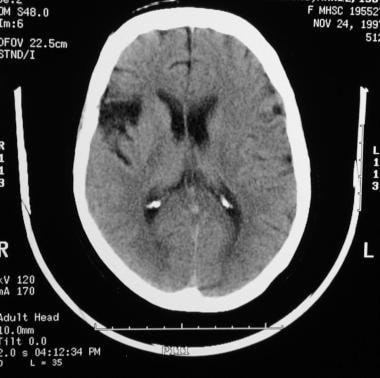 A 60-year-old patient presented with right cerebra