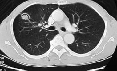 Computed tomography scan, pulmonary window setting