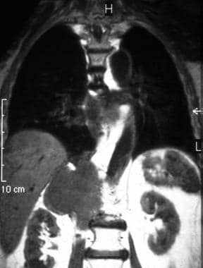 T1-weighted coronal MRIs of the thorax in a 55-yea