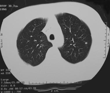 CT scan of a small solitary pulmonary nodule in th