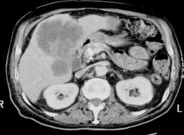 Computed tomography (CT) scan in a 65-year-old man