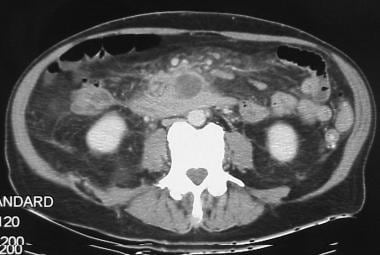 CT scan of a pseudocyst causing gastric outlet obs