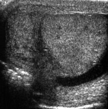 Transverse ultrasonogram of the testis shows an en