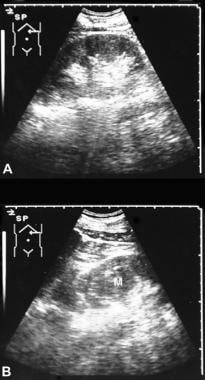 Top, Longitudinal sonogram obtained thorough the l