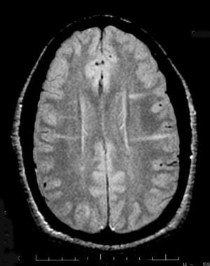 Axial proton density–weighted MRI in a 10-year-old