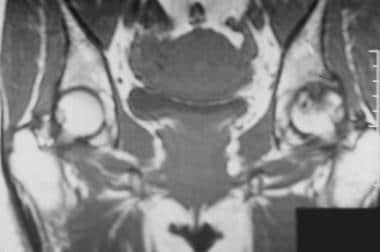 Coronal T1-weighted magnetic resonance image of th