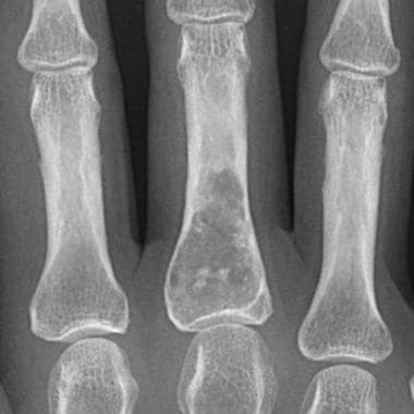 Enchondroma. 62-year-old woman with enchondroma in