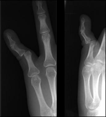 Finger and Thumb Trauma Imaging: Overview, Radiography, Computed Tomography