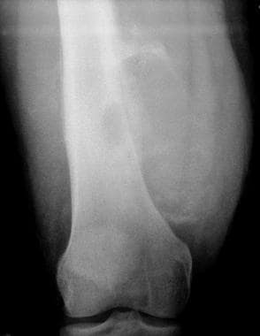 Frontal radiograph of the distal femur in a patien