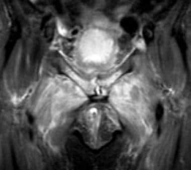 septic arthritis xray