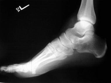 Lateral radiograph of the foot in a 60-year-old ma