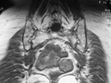 An area of hyposignal is noted in the T1 sequence 