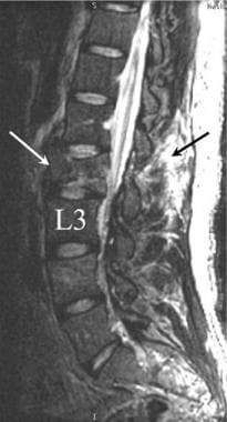 Sagittal T2-weighted MRI of an L2 compression frac