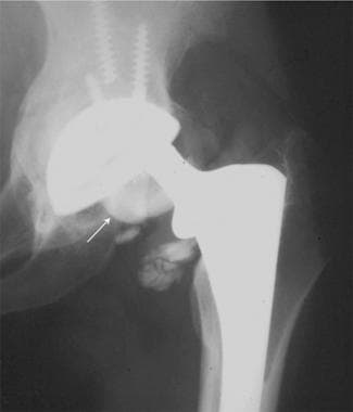 Image from a patient who had a prosthesis failure 