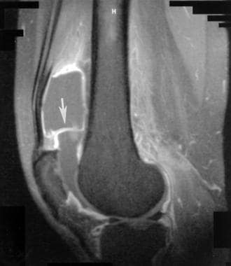 Extensor mechanism injuries of the knee. Sagittal 