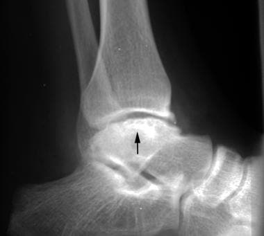 Radiograph of the ankle in a 20-year-old patient w