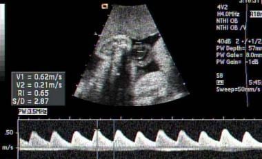 Normal spectral Doppler waveform of umbilical arte