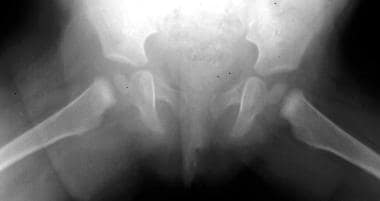 Frontal radiograph of the pelvis obtained with the