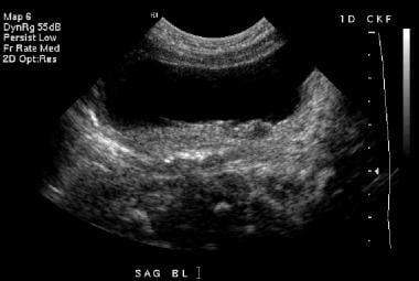 Transverse sonogram of the bladder (same patient a