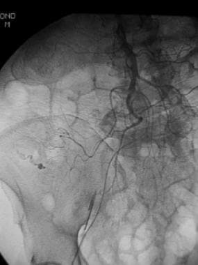 Superior mesenteric arterial arteriogram shows ext