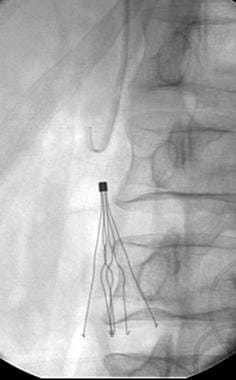 A catheter was advanced over the wire and used to 