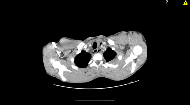 CT scan of the thorax of a sixteen-year-old with L