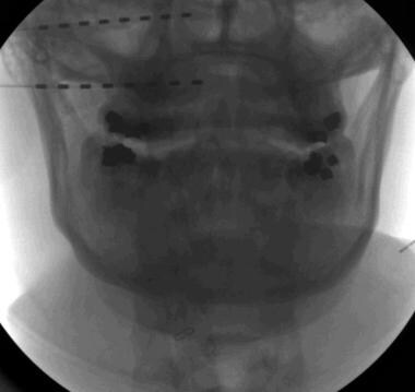 A fluoroscopic images of occipital leads showing s