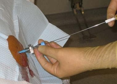 Paracentesis. Advancing catheter over needle. 