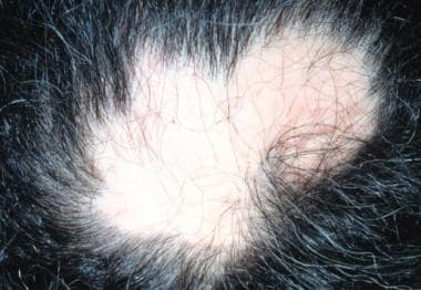 Irregularly shaped patch of scarring alopecia on t