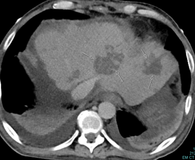 C-5: Multiple infarctions of the left lateral aspe