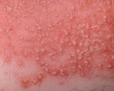 Fine superficial pustules on an erythematous patch