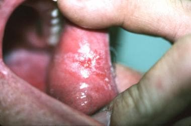 vesicular lichen planus