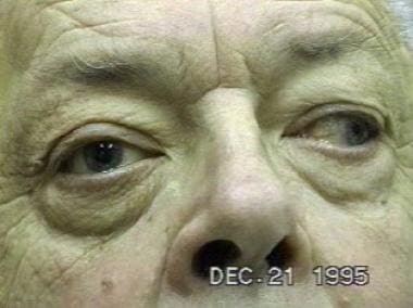 Typical pupil in third nerve palsy, with mydriasis